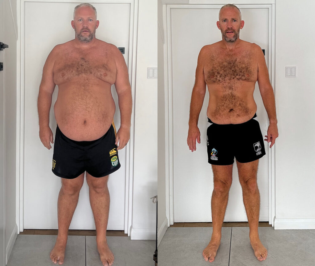 Before and after image of gastric sleeve progress and results