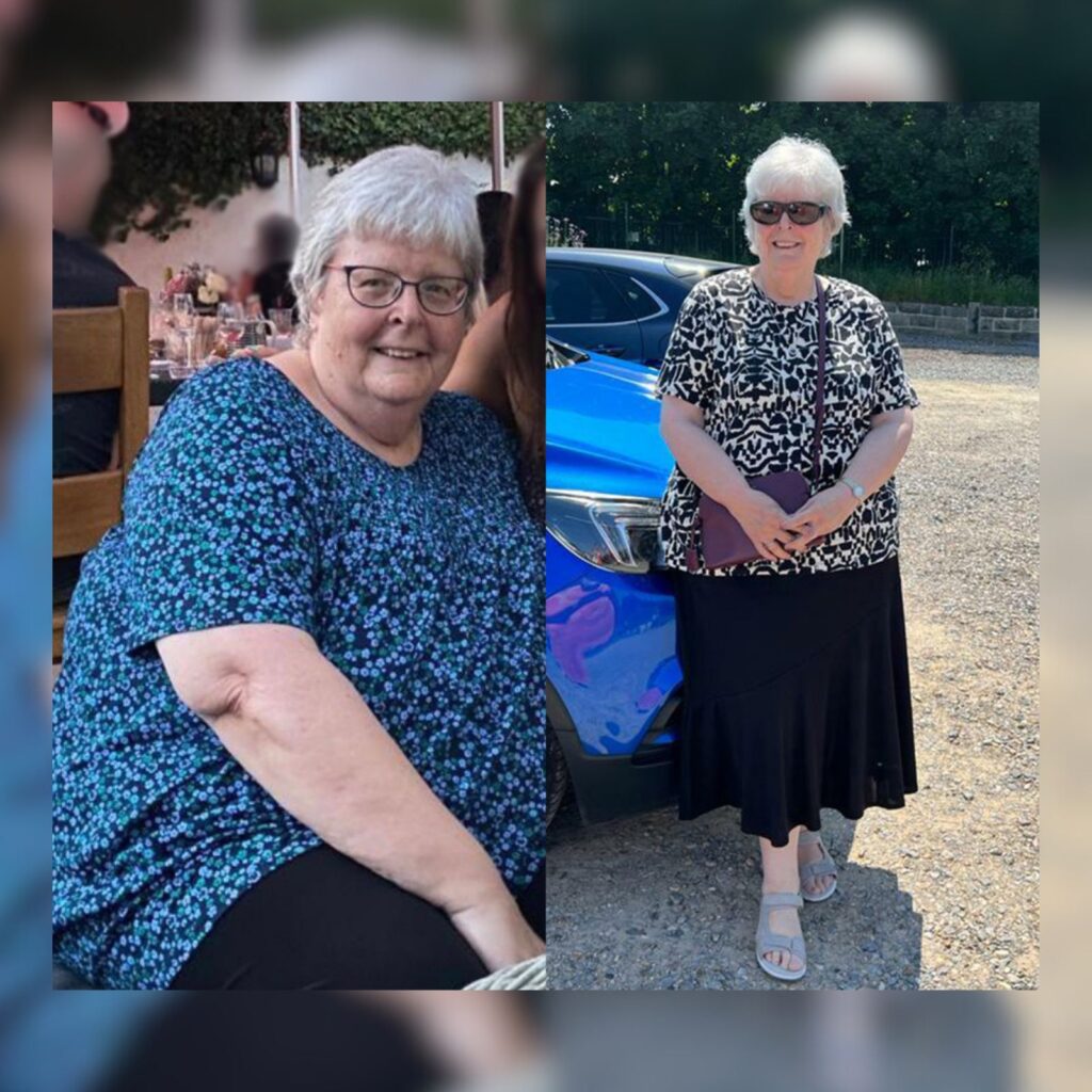 Gastric band to bypass revision before and after by Dr. Vasilikostas