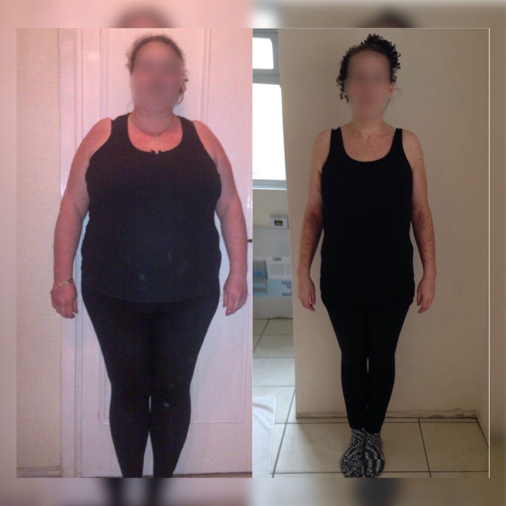 Gastric bypass weight loss transformation by Dr. Vasilikostas
