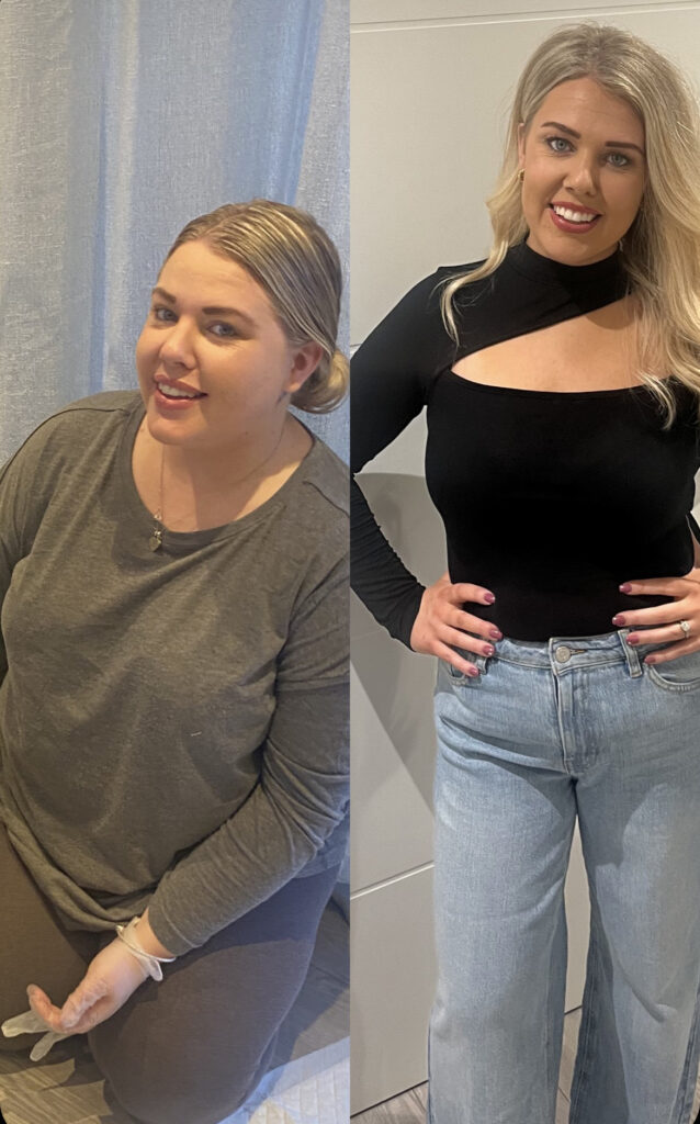Gastric sleeve weight loss transformation photo Dr Vasilikostas