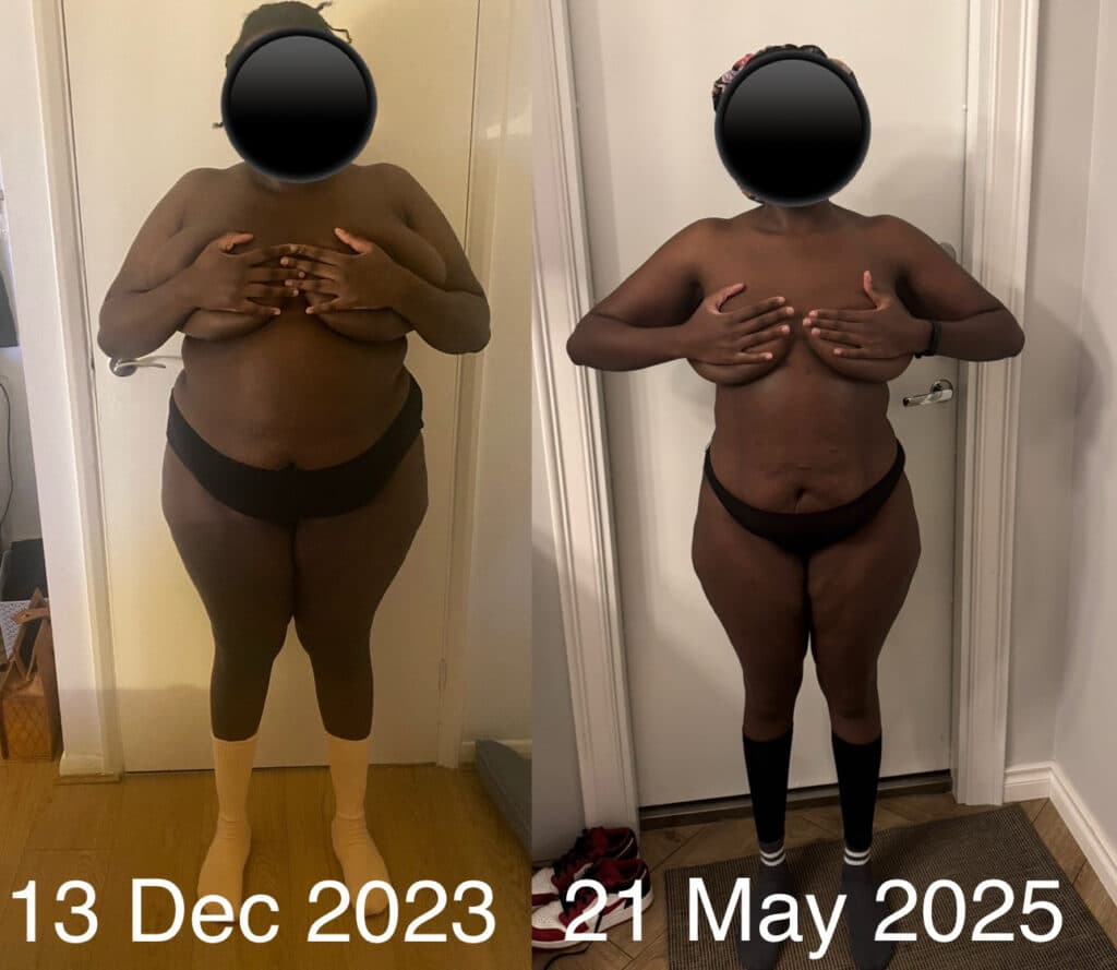 Gastric Bypass Before and After Photo by Dr. Vasilikostas in London UK