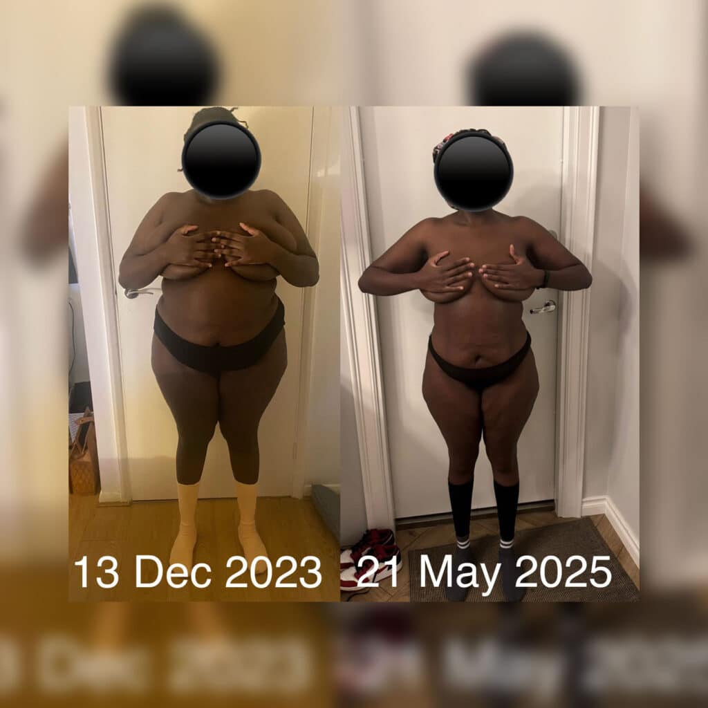 Gastric Bypass Before and After Photo by Dr. Vasilikostas in London UK blurred